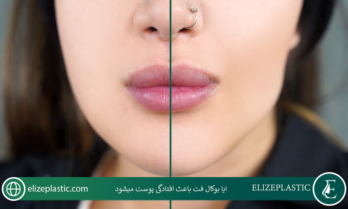 ایا بوکال فت باعث افتادگی پوست می‌شود 